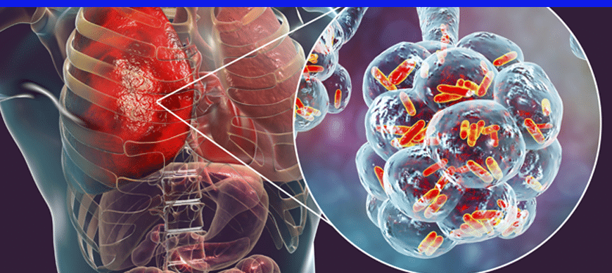 [ARTICLE] Découvrez comment Coriolis μ a été utilisé pour surveiller la légionellose dans les établissements de santé. Bertin Technologies 60141